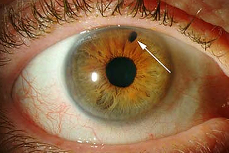 Iridotomia — Tratamento de Glaucoma